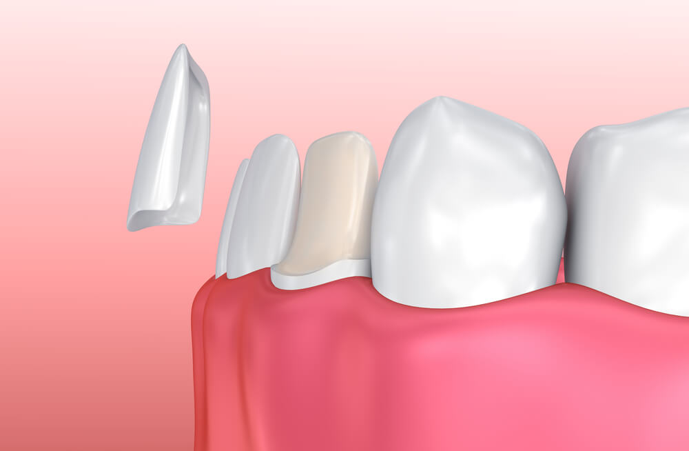 CGI image illustrating how application of porcelain veneers works. A white, thin porcelain shell is being placed over a discolored tooth.