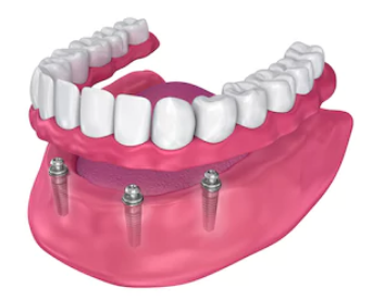 All-On-4 Dental Implants