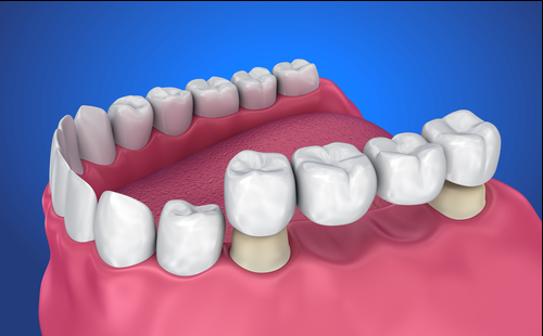 Dental bridge