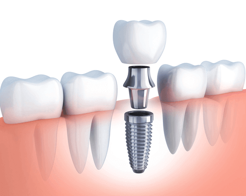 Tooth implant