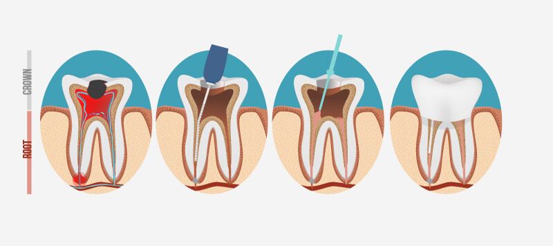 Endodontic Procedure